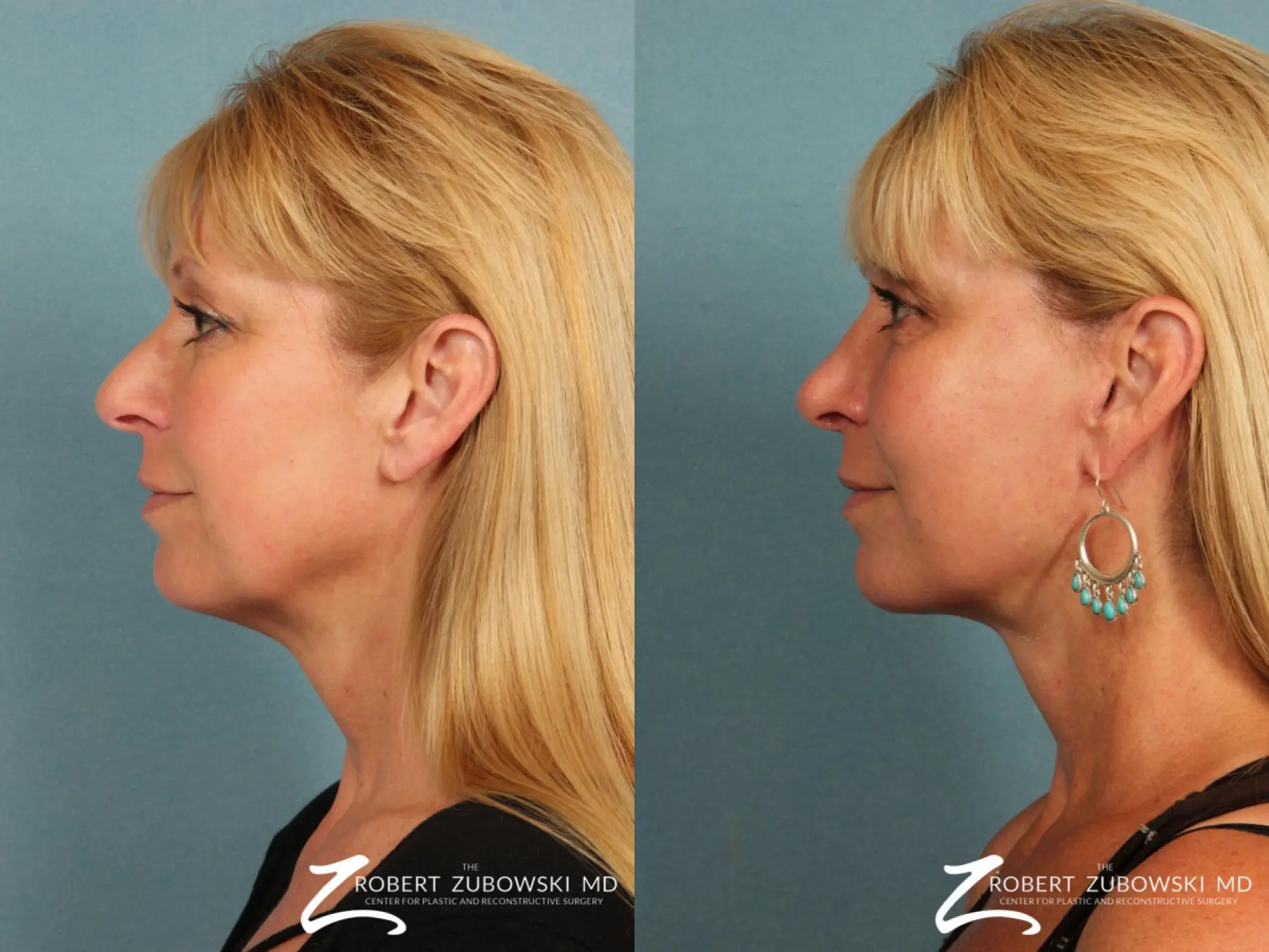 Facelift: Patient 5 - Before and After 2