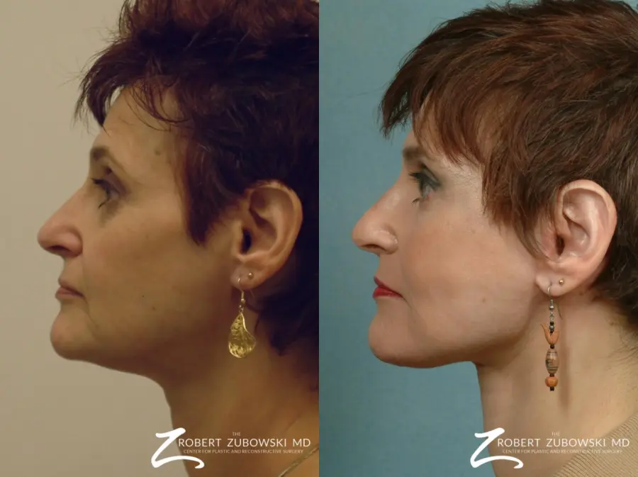 Facelift: Patient 24 - Before and After 2