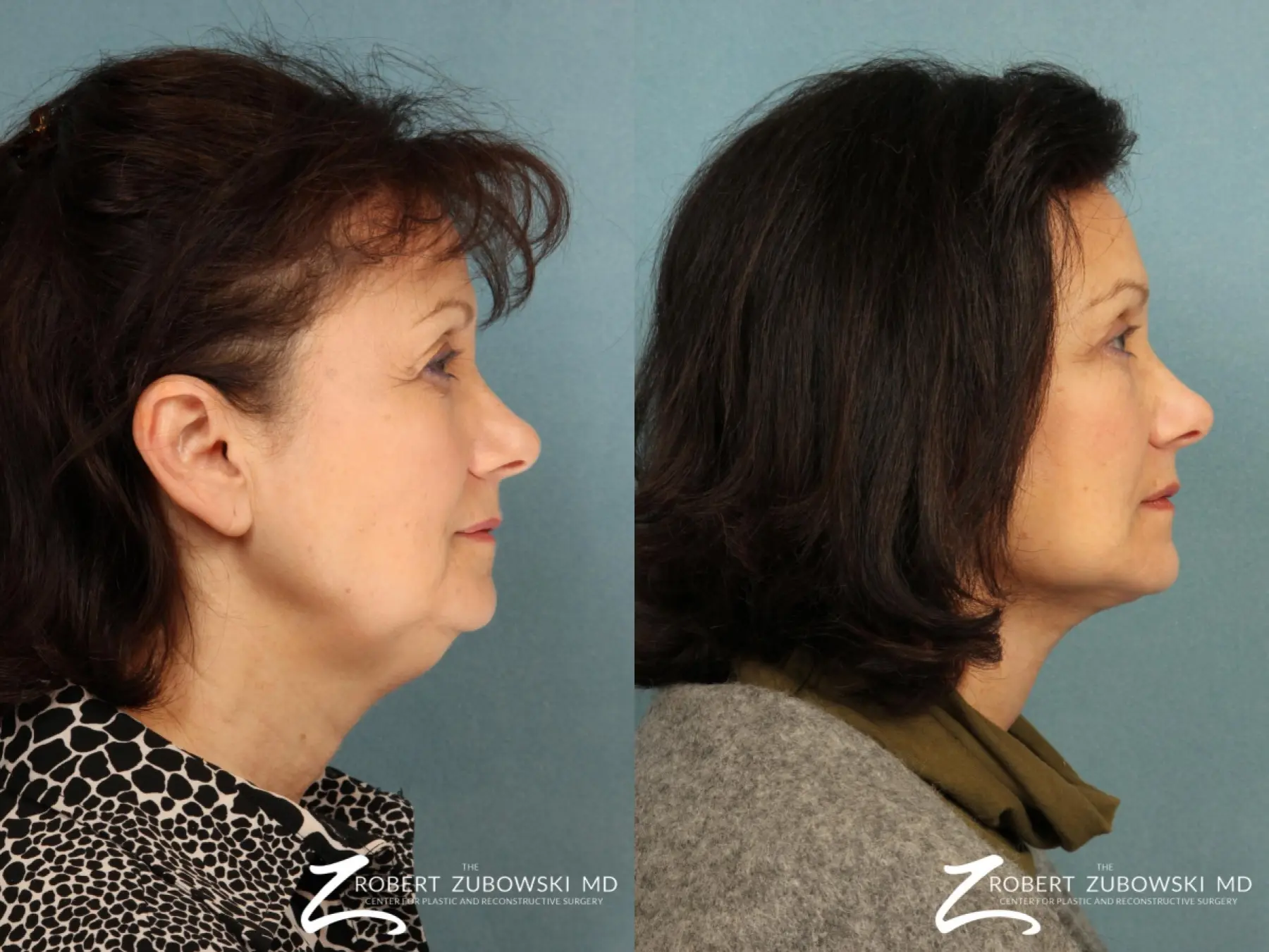 Facelift: Patient 11 - Before and After 2