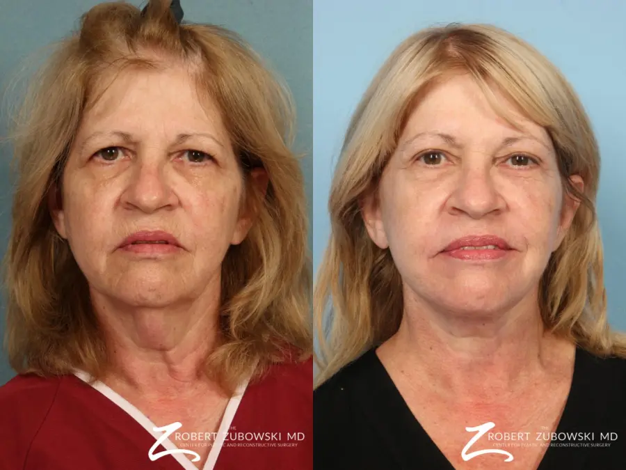 Facelift: Patient 23 - Before and After  