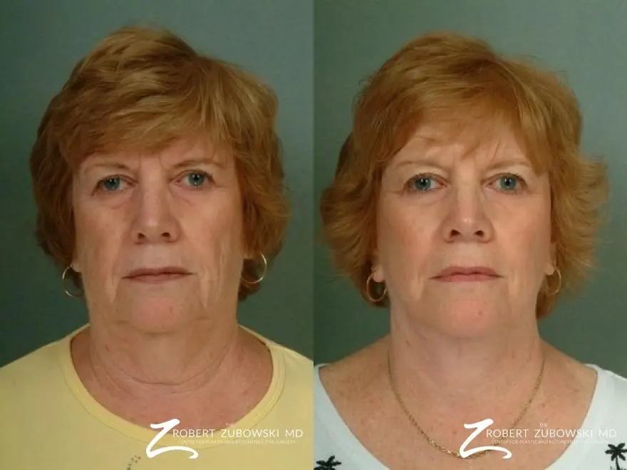 Facelift: Patient 8 - Before and After  