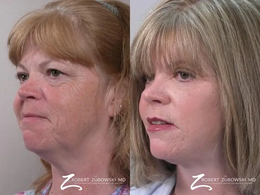 Facelift: Patient 18 - Before and After 2