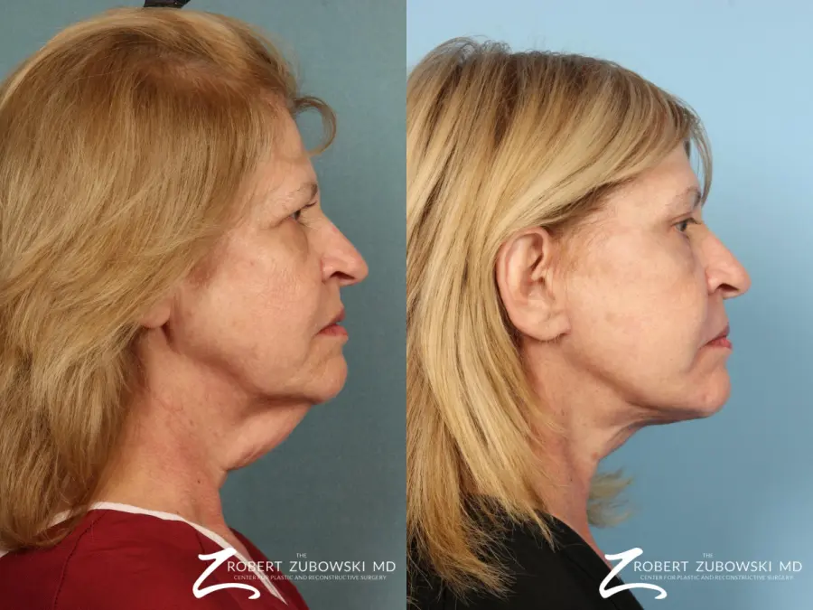 Facelift: Patient 15 - Before and After 2