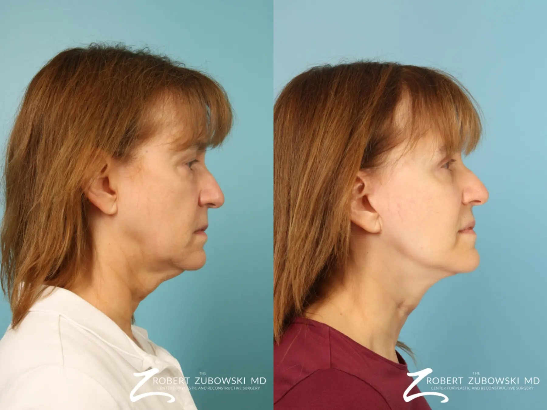 Facelift: Patient 32 - Before and After 2