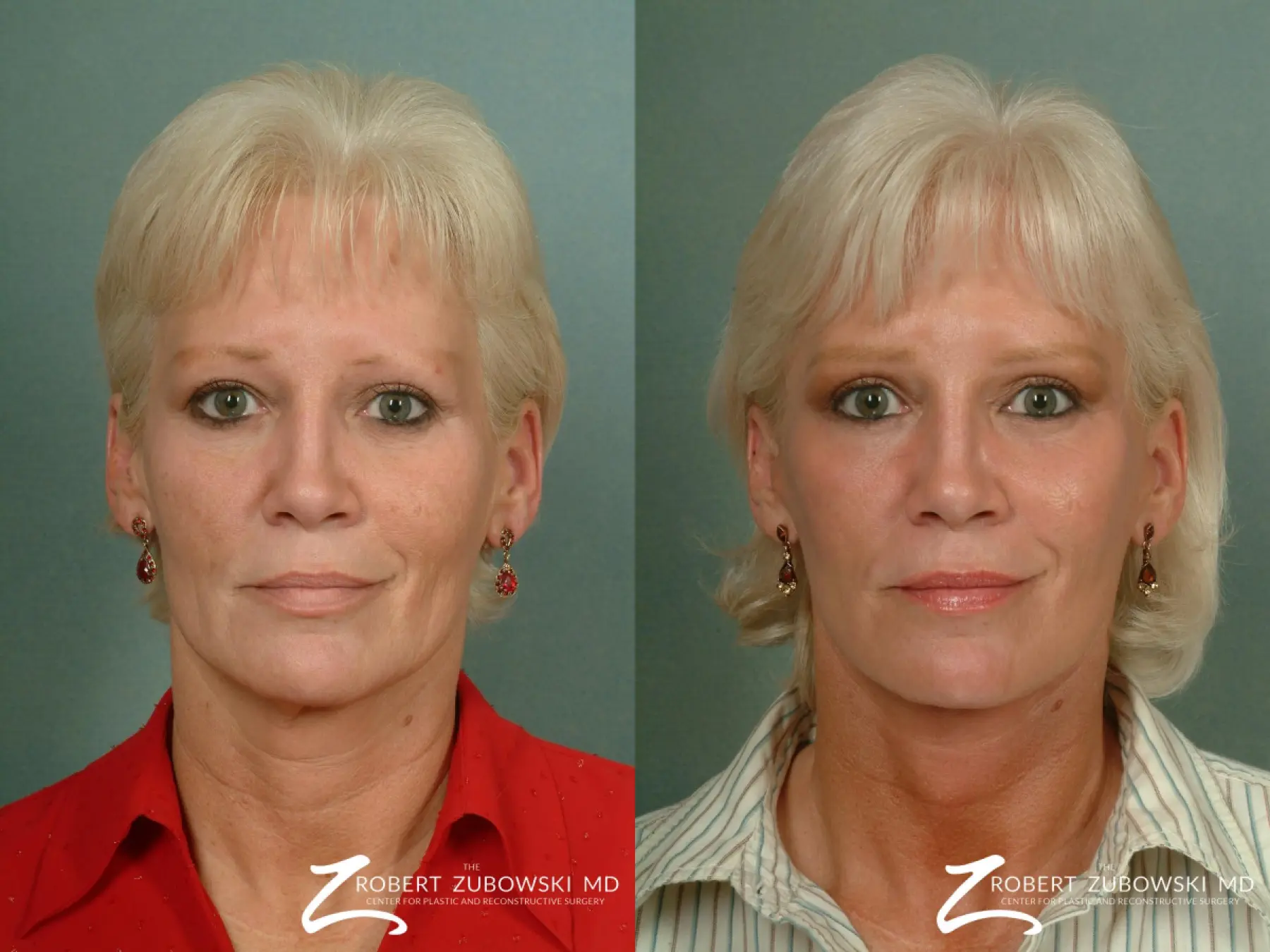 Facelift: Patient 12 - Before and After  