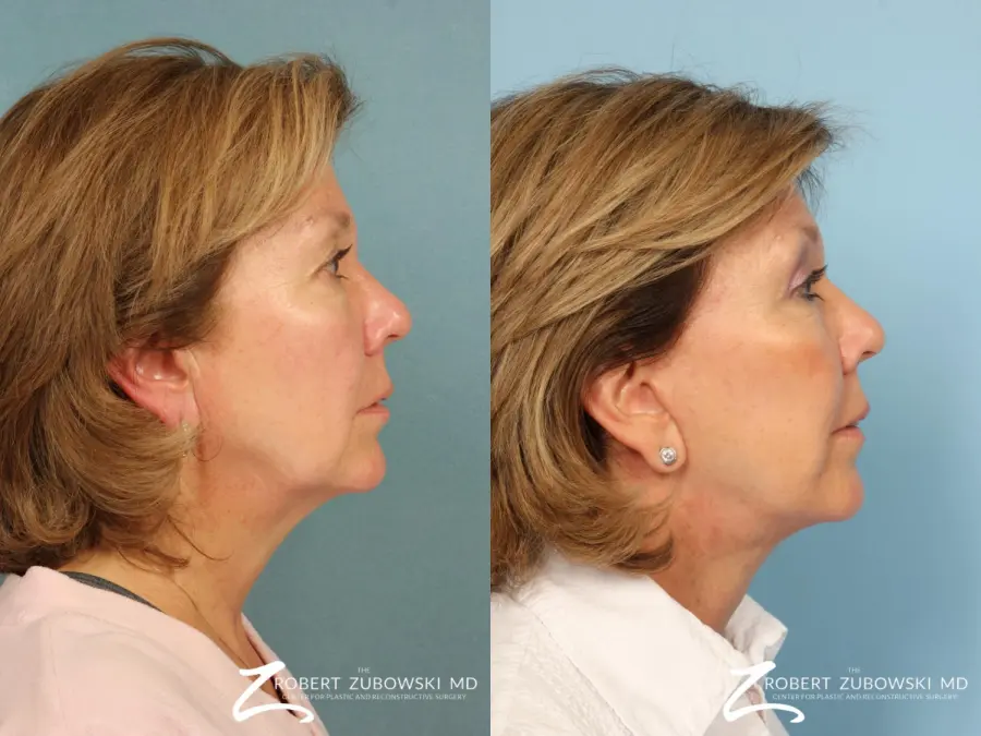Facelift: Patient 3 - Before and After 2