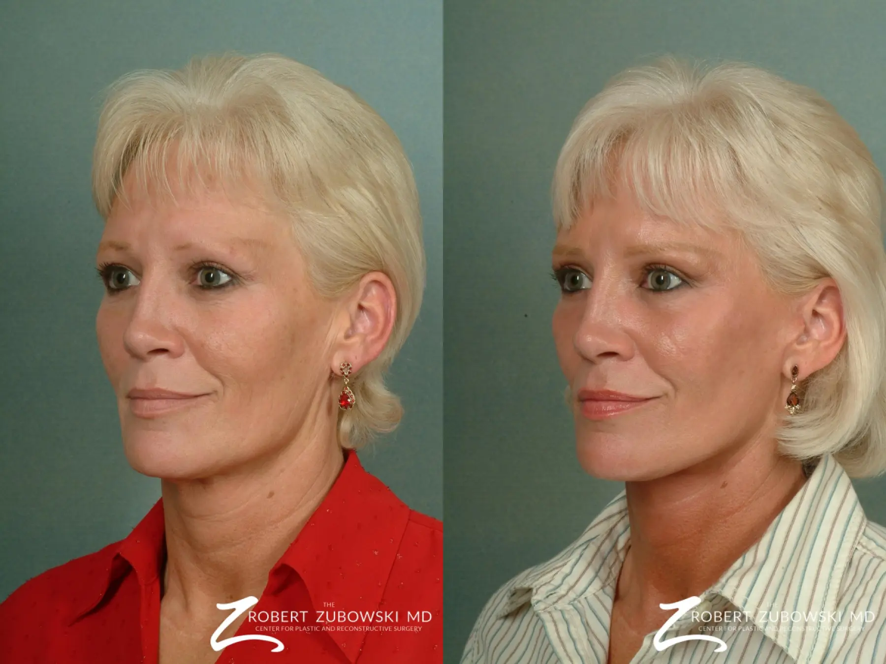 Facelift: Patient 12 - Before and After 2