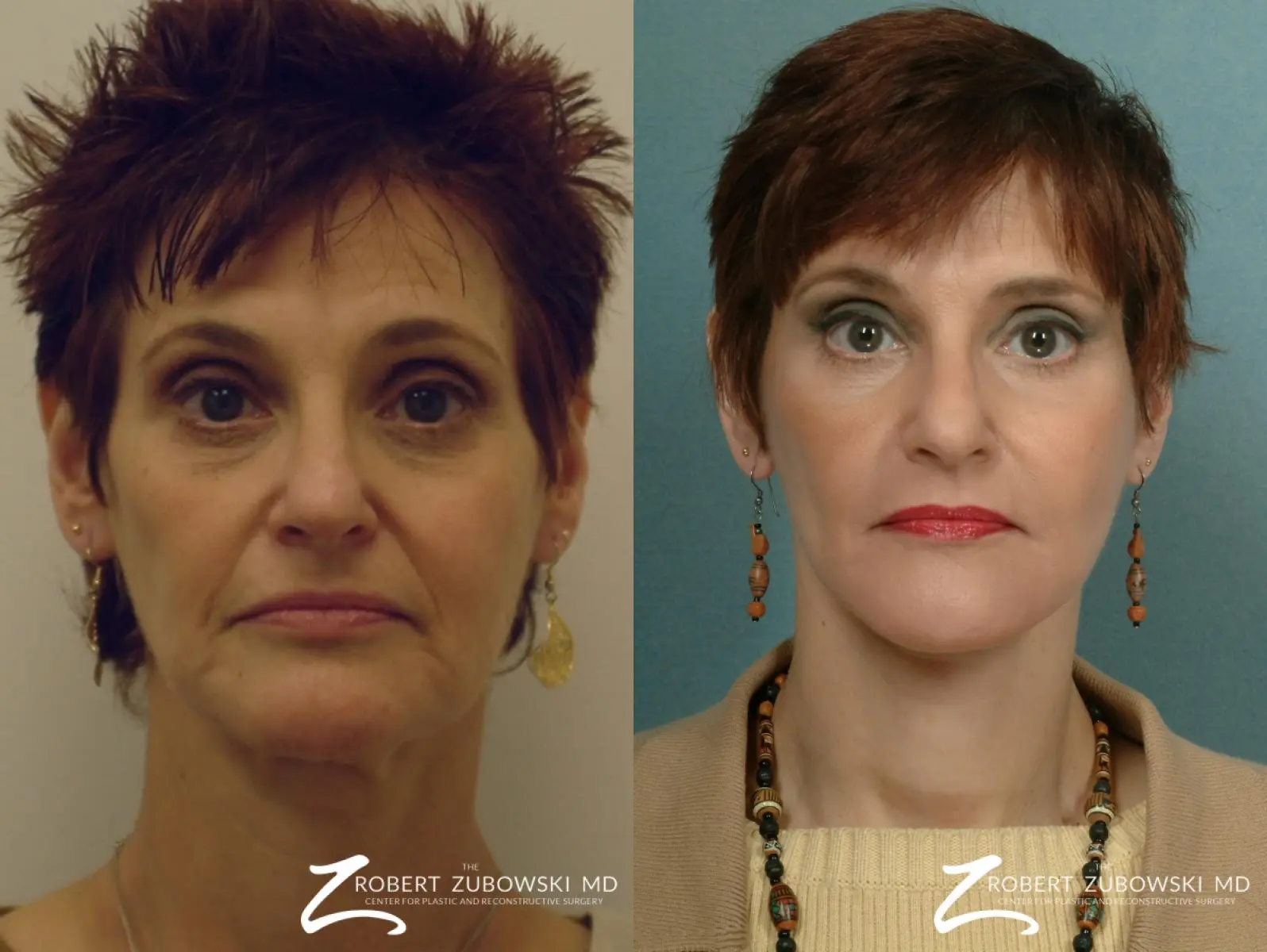 Facelift: Patient 24 - Before and After  