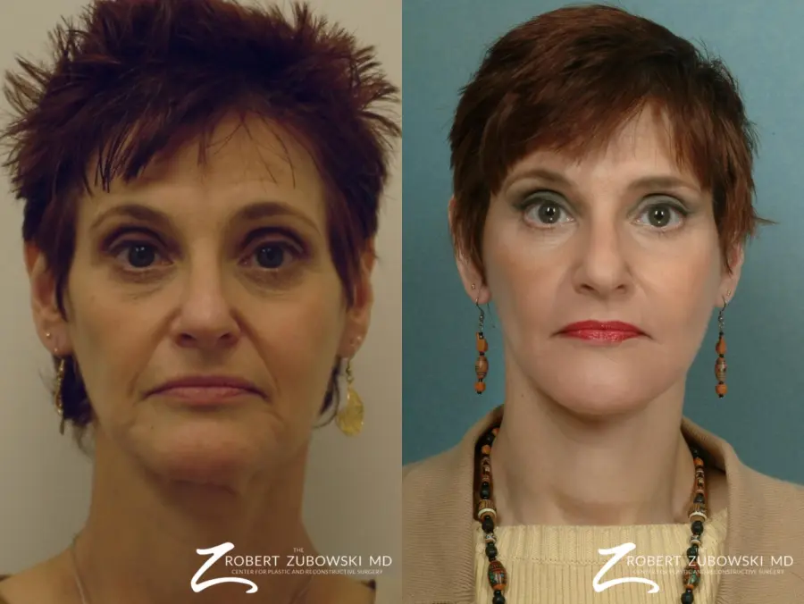 Facelift: Patient 8 - Before and After  