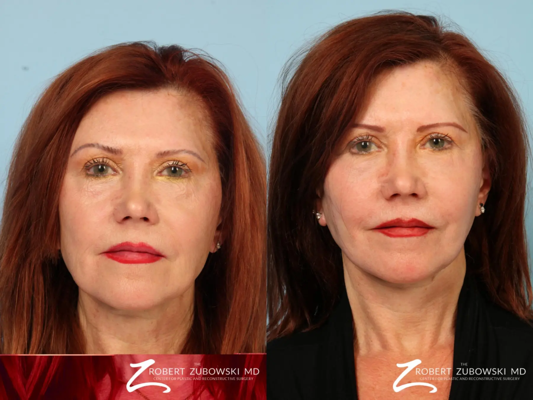 Facelift: Patient 17 - Before and After  