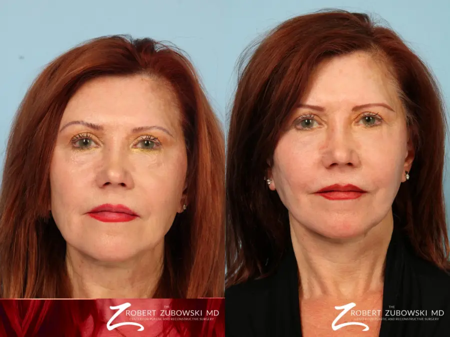 Facelift: Patient 17 - Before and After 1