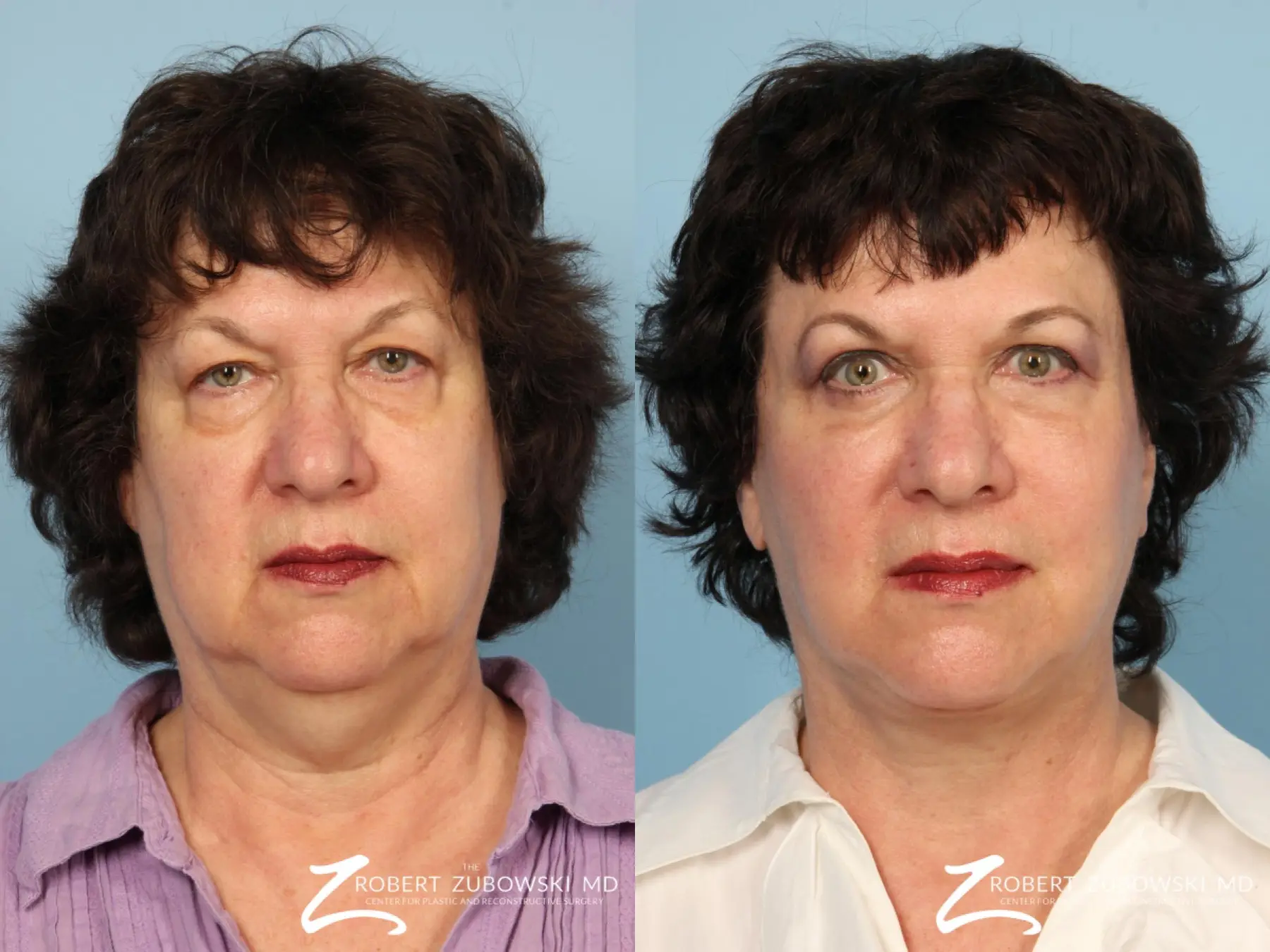 Facelift: Patient 26 - Before and After  