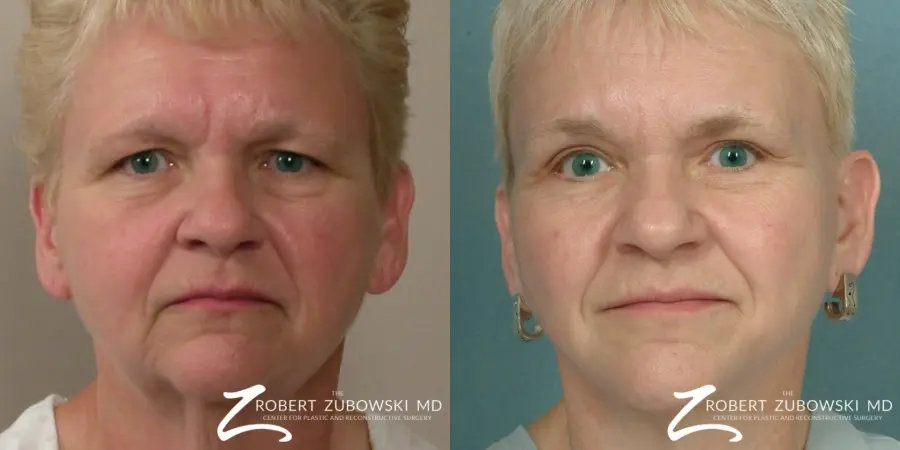 Facelift: Patient 28 - Before and After 1