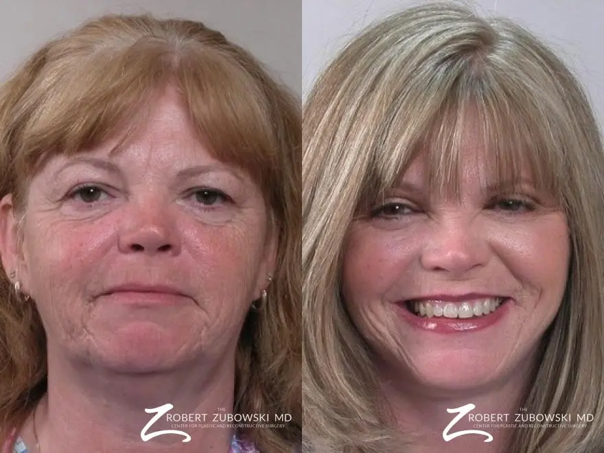 Facelift: Patient 18 - Before and After  