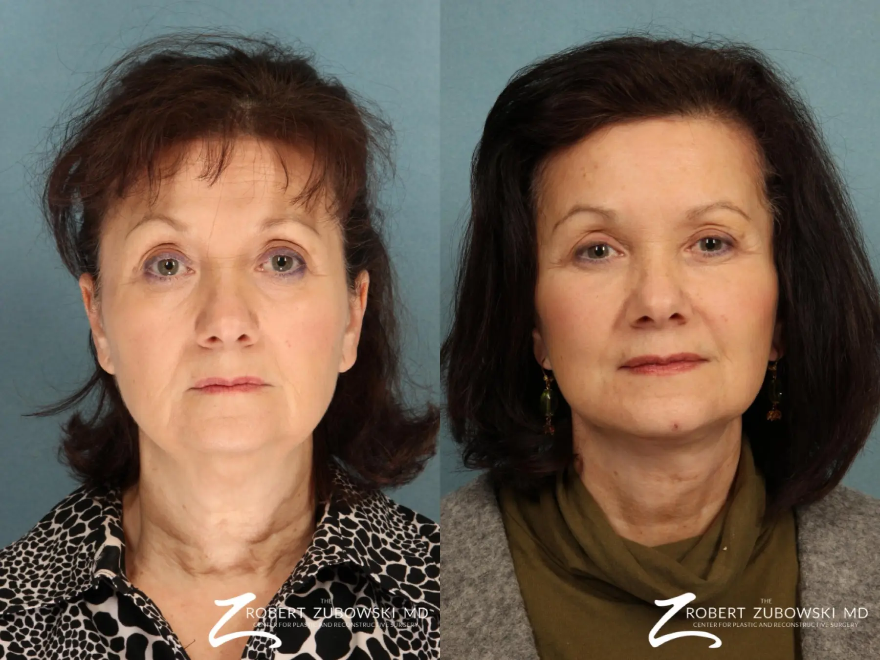 Facelift: Patient 11 - Before and After  