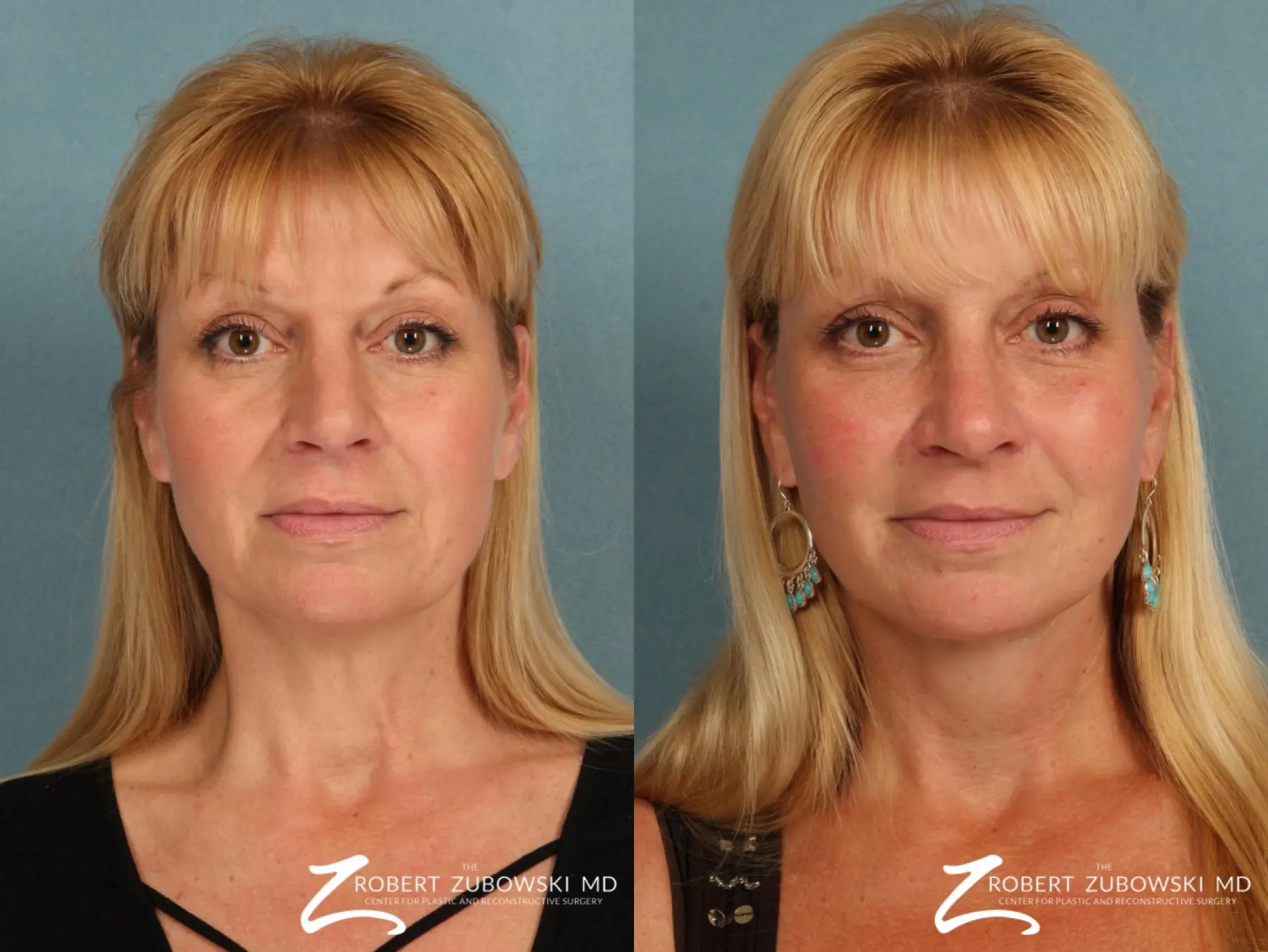 Facelift: Patient 5 - Before and After  