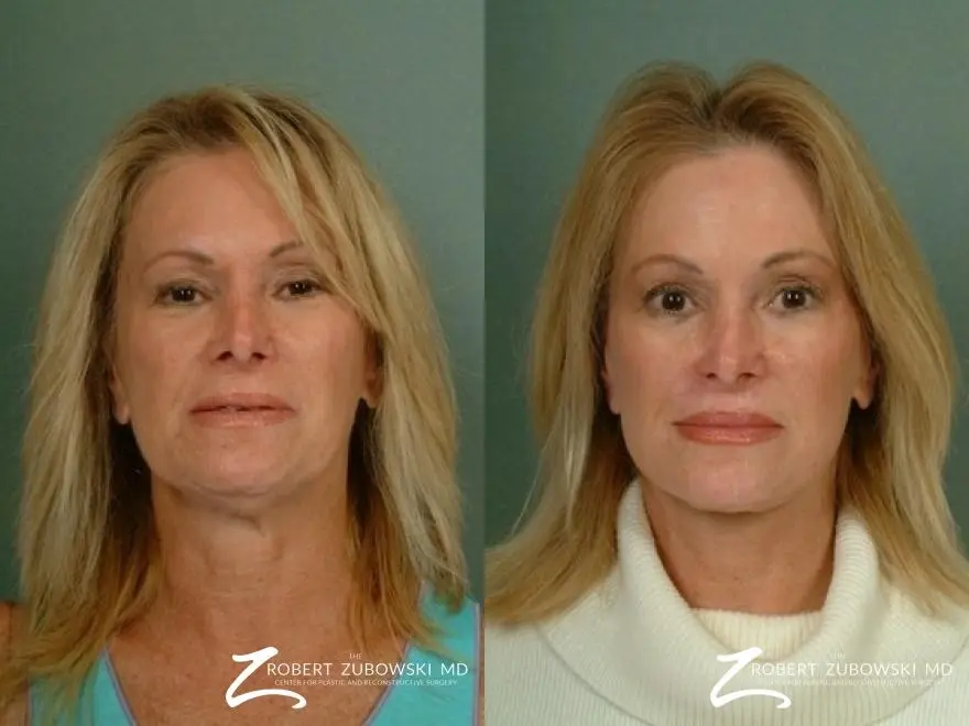 Facelift: Patient 7 - Before and After  