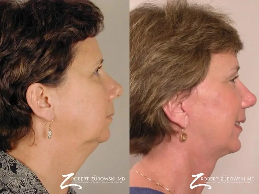 Facelift: Patient 19 - Before and After 2
