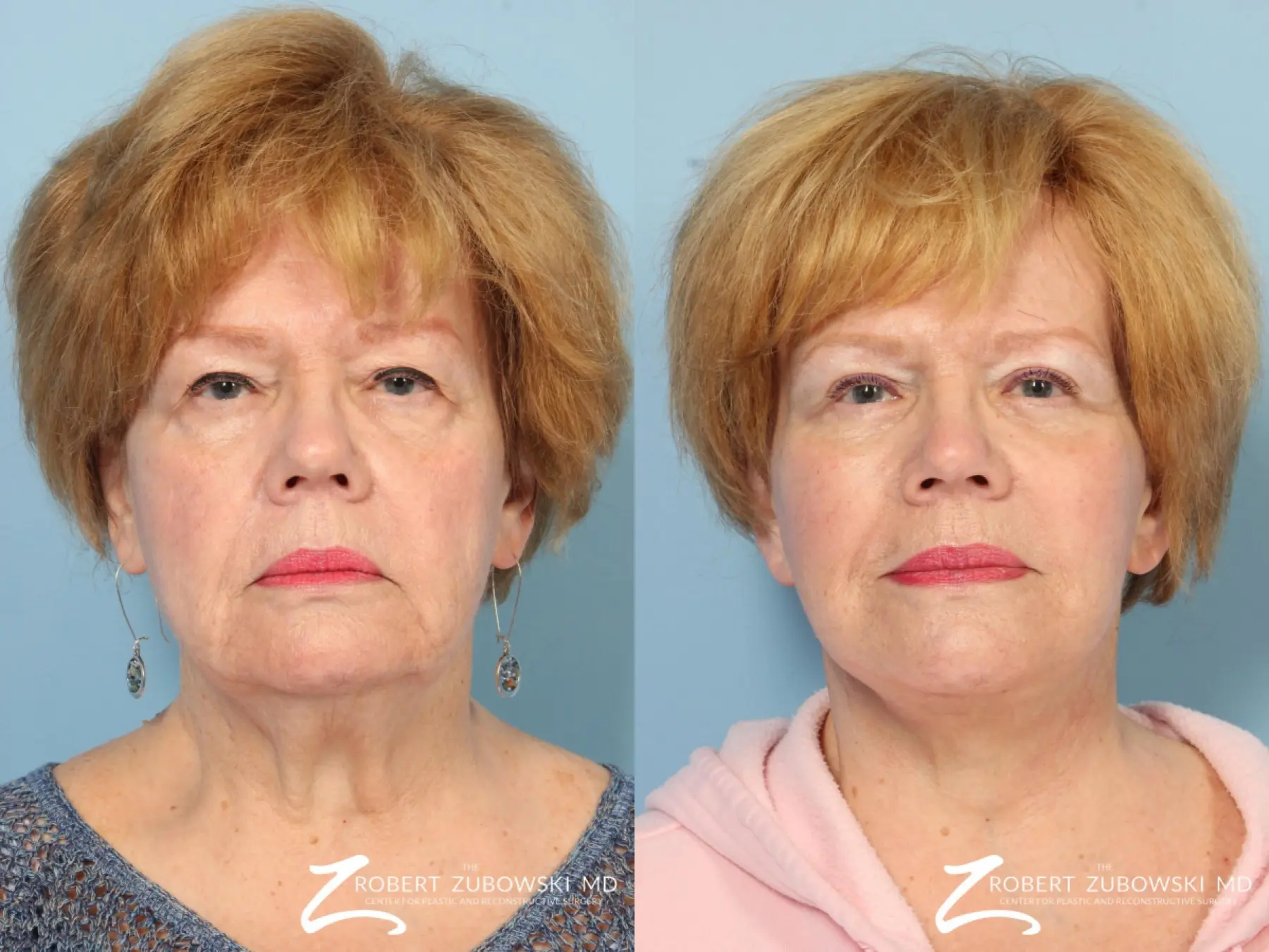 Facelift: Patient 25 - Before and After  