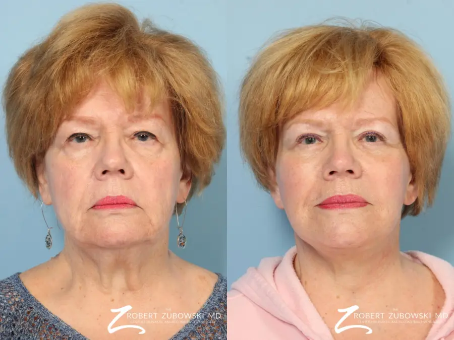 Facelift: Patient 24 - Before and After  