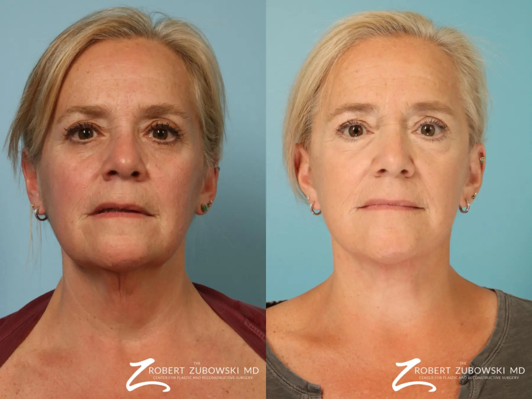 Facelift: Patient 30 - Before and After  