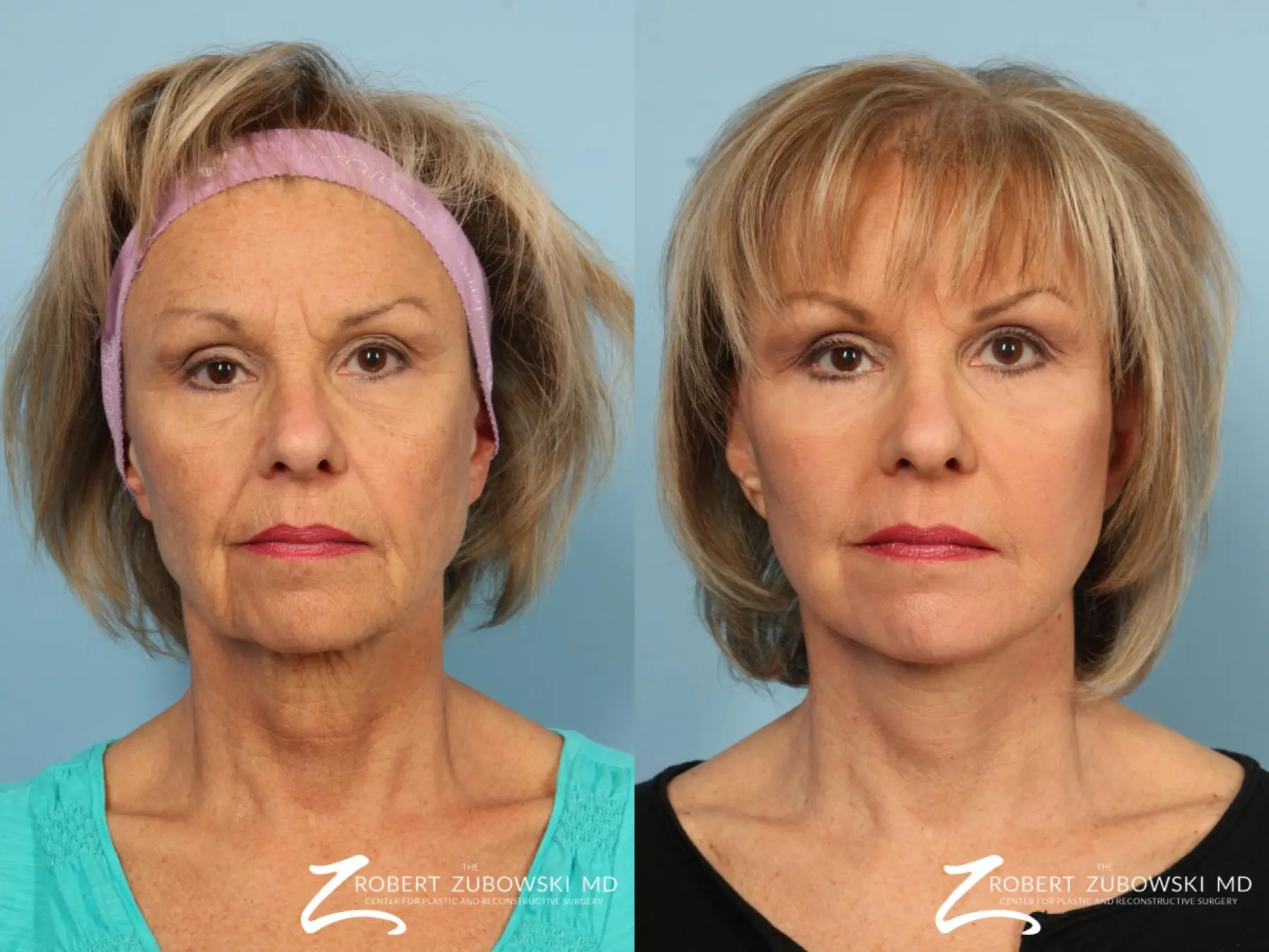 Facelift Before & After Gallery: Patient 1