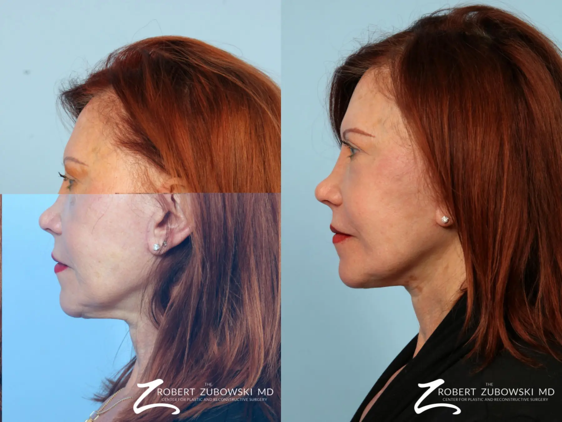 Facelift: Patient 17 - Before and After 2