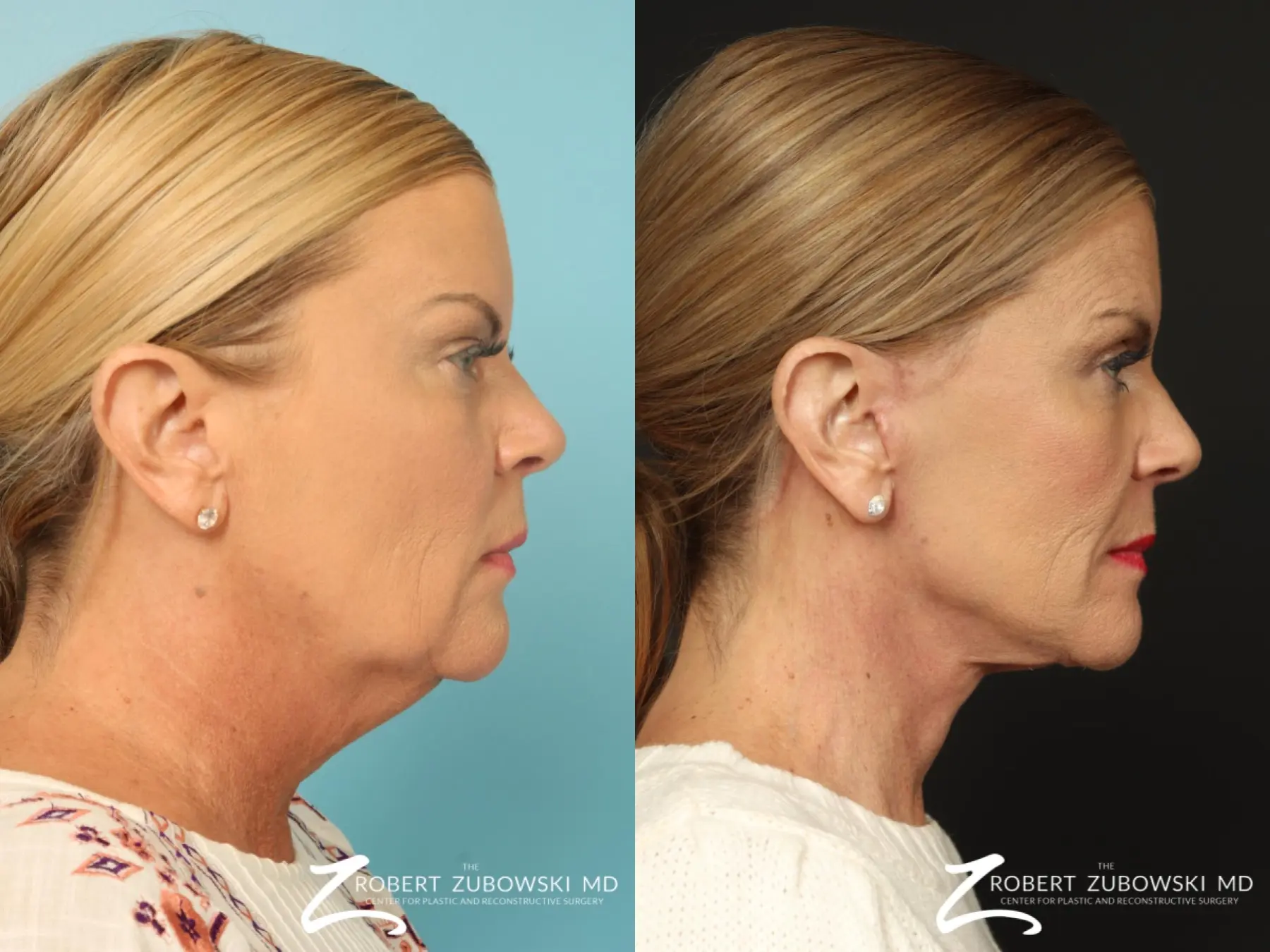 Facelift: Patient 33 - Before and After 2