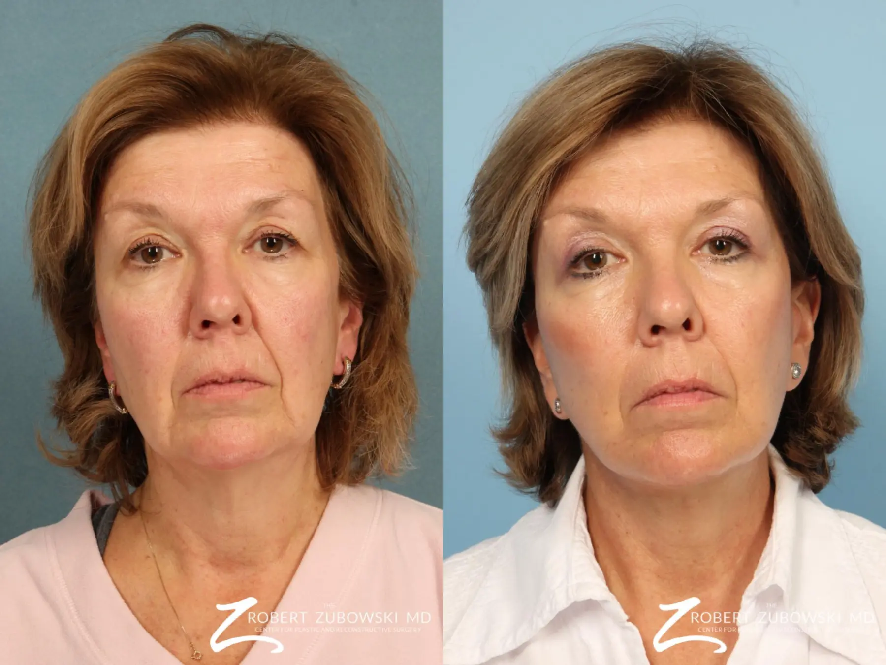 Facelift: Patient 3 - Before and After  