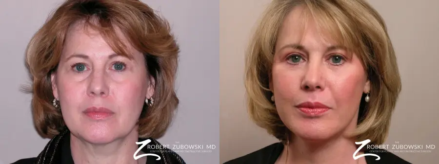 Facelift: Patient 29 - Before and After 1