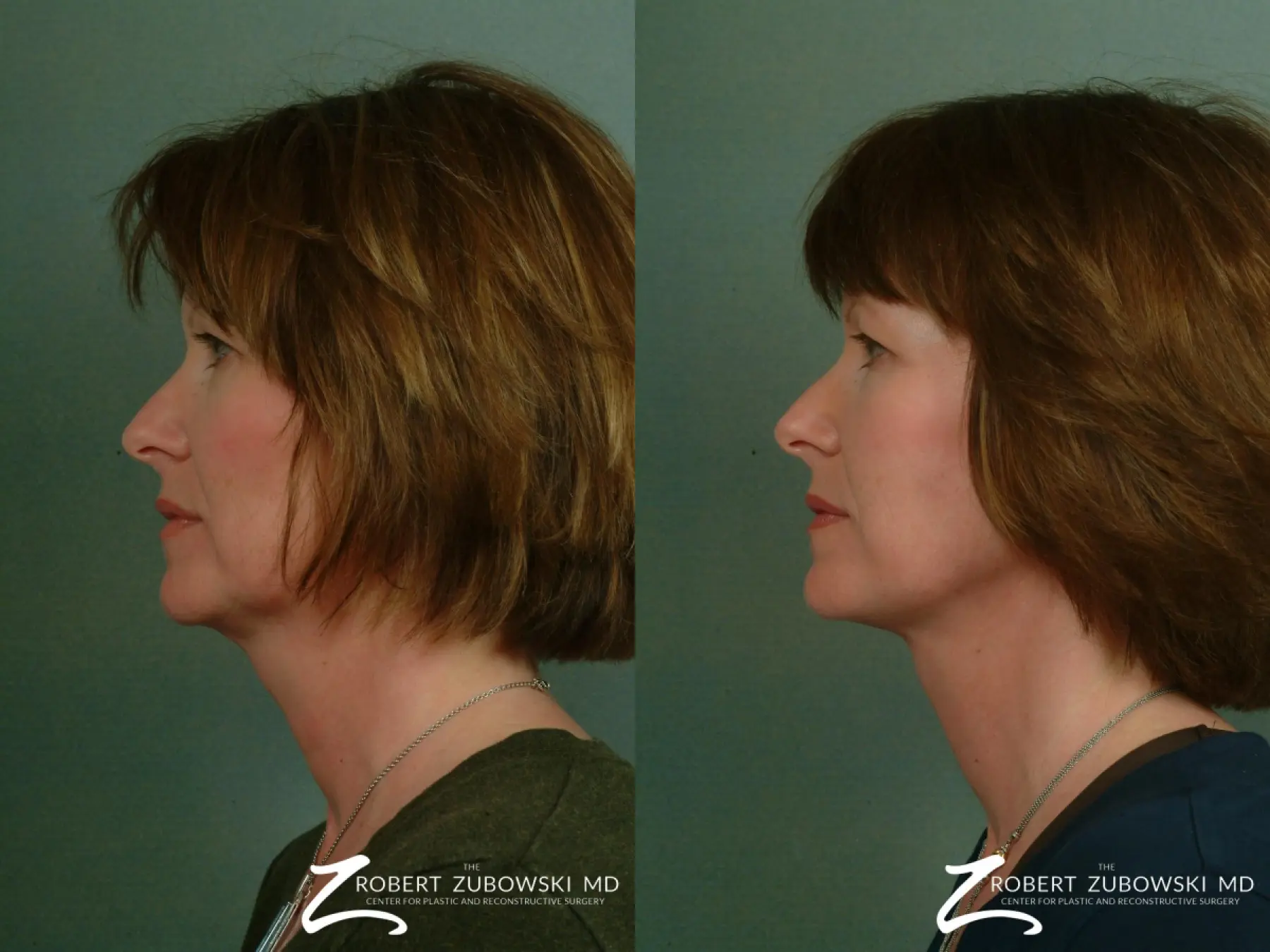 Facelift: Patient 20 - Before and After 2