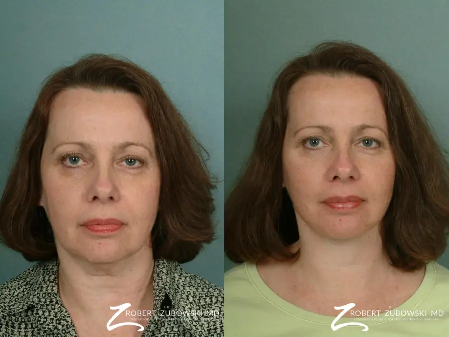 Facelift: Patient 10 - Before and After  