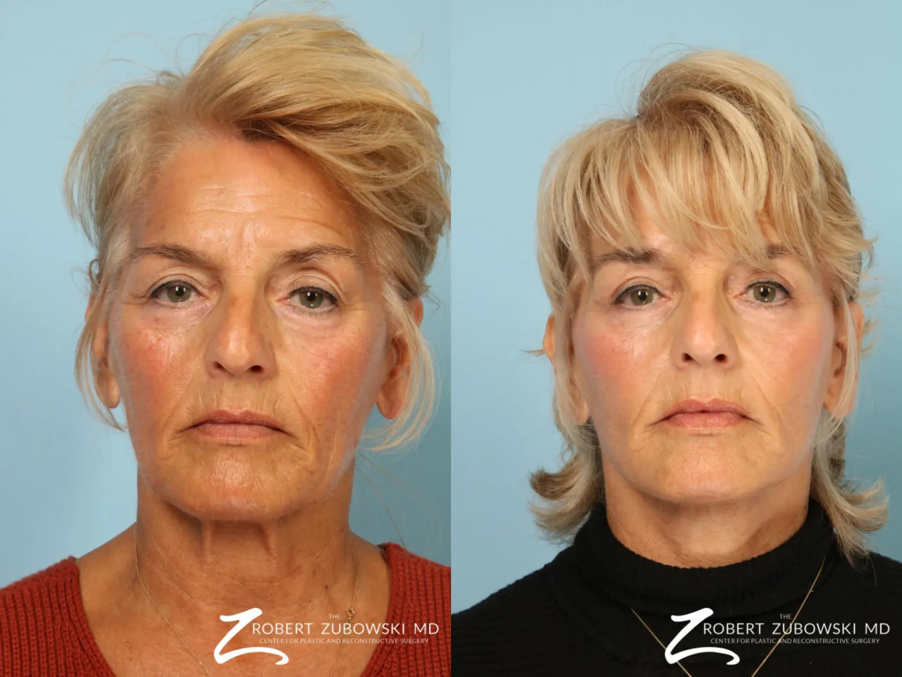 Facelift: Patient 6 - Before and After  