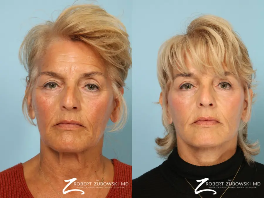 Facelift: Patient 29 - Before and After  