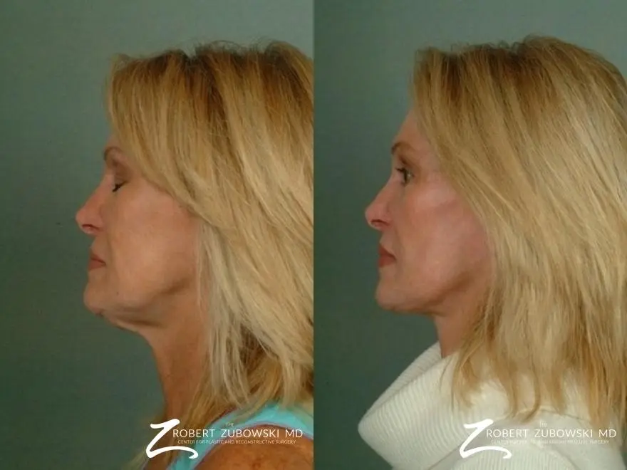 Facelift: Patient 7 - Before and After 2