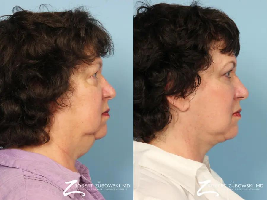 Facelift: Patient 26 - Before and After 2