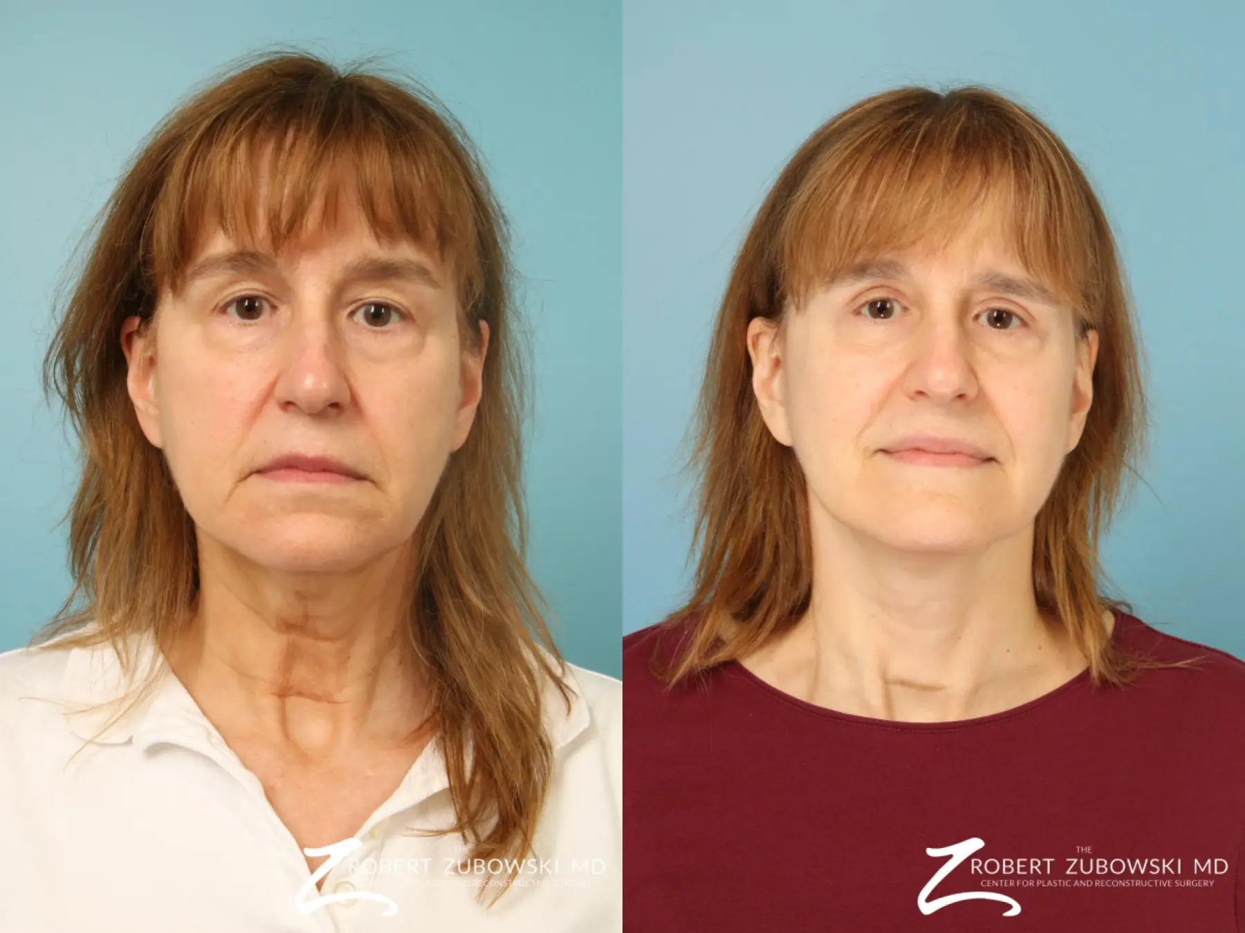 Facelift: Patient 32 - Before and After  
