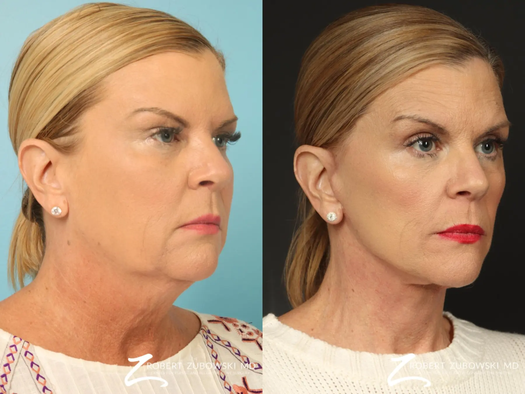 Facelift: Patient 33 - Before and After 3