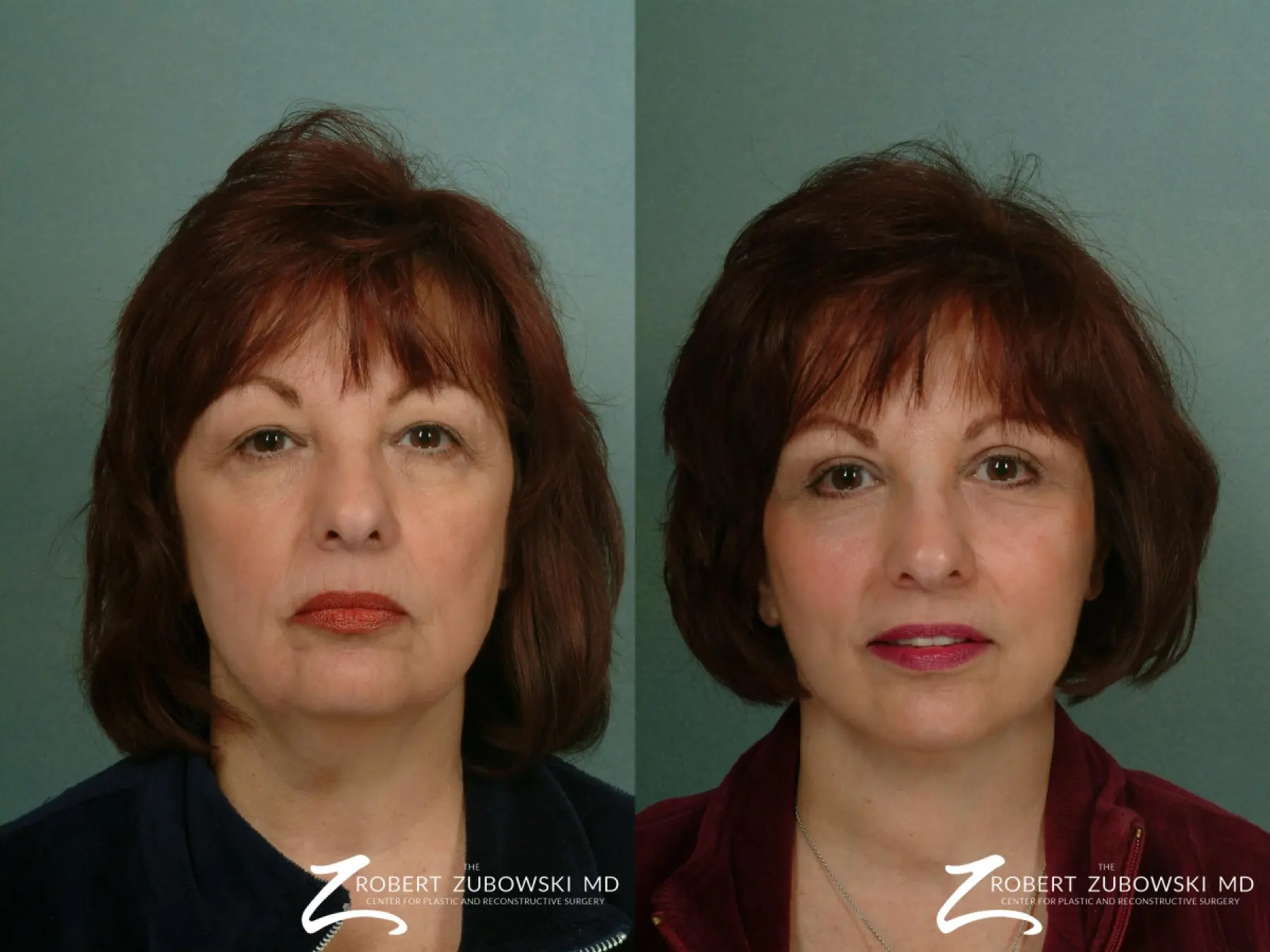 Facelift: Patient 23 - Before and After  