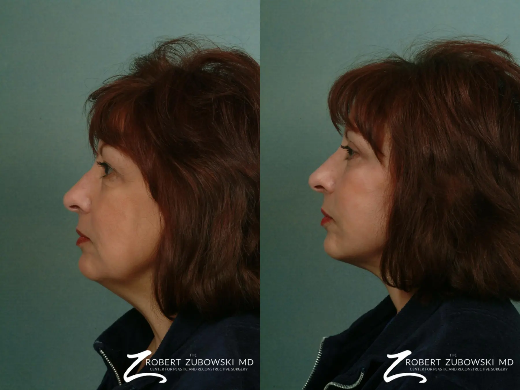 Facelift: Patient 23 - Before and After 2