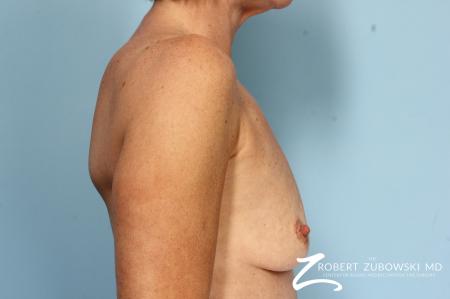 Breast Augmentation: Patient 38 - Before Image 2