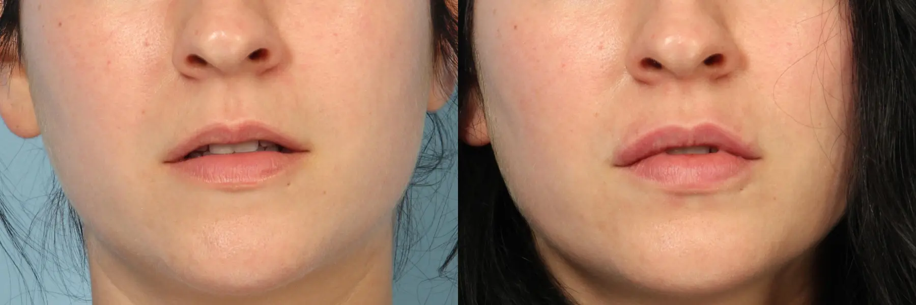 Fillers: Patient 2 - Before and After 1