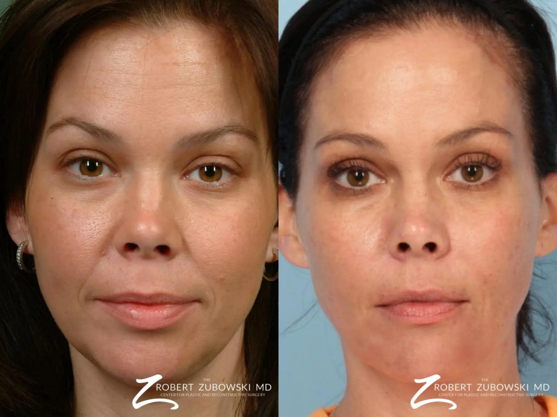 Fillers: Patient 1 - Before and After  