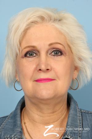 Blepharoplasty: Patient 26 - After Image 1