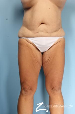 Thigh Lift: Patient 4 - Before Image 1