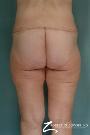 Body Lift: Patient 2 - After Image 2
