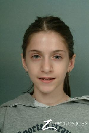 Otoplasty: Patient 6 - After Image 1