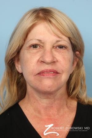 Facelift: Patient 23 - After Image 1