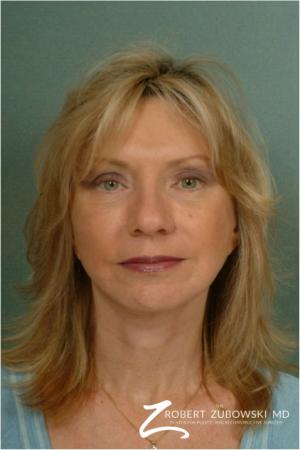 Brow Lift: Patient 4 - After Image 1