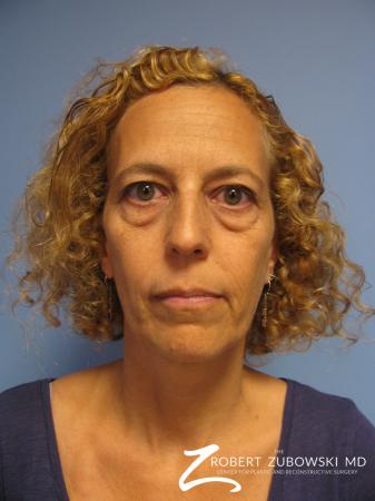 Blepharoplasty: Patient 29 - Before Image 1